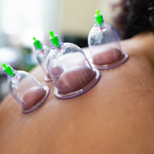 cupping-Elite-Sports-Physio-and-Massage-Chilliwack-BC